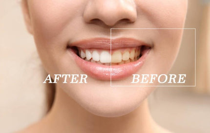 Teeth Whitening Kit with Led Light